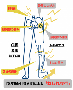 ねじれ歩行